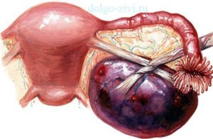 Киста яичника и бесплодие
