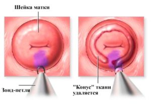 Конизация шейки матки и киста копчика