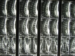 Болит спина МРТ