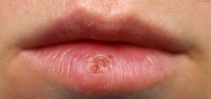 Болячки на губе и рядом с губой
