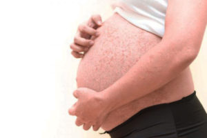 Краснуха беременность