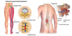 Боли в спине в поясничном отделе, отнимается нога