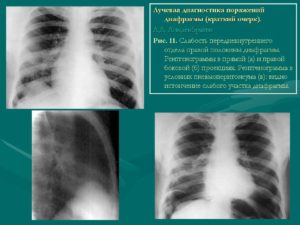 Корни усилены cos-n, релаксация обоих куполов диафрагмы