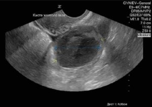 Киста желтого тела эко