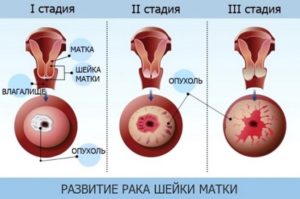 Кровотечение, гемоглобин 47 при раке шейки матки