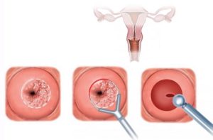 Кровянистые выделения после биопсии шейки матки
