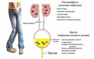 Боли в области почки при полном мочевом пузыре