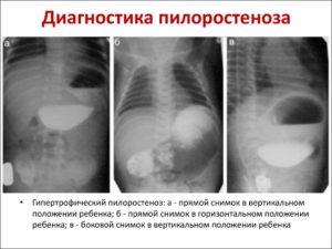 Пилоростеноз