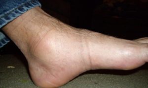 Боль в ноге в районе лодыжки