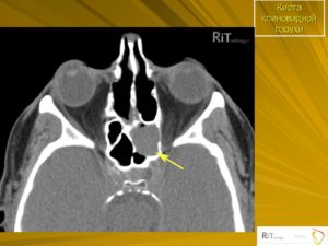 Киста основной пазухи