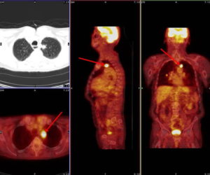 ПЭТ/КТ очаговое образование на легком