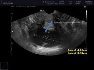 Какое узи сделать киста правого яичника