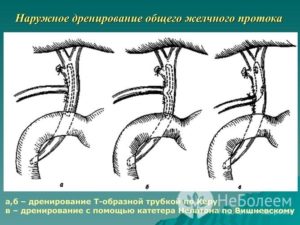 Механическая желтуха после удаления желчного