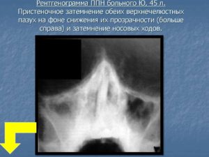 Лечение по поводу пристеночного затемнения в/ч пазух