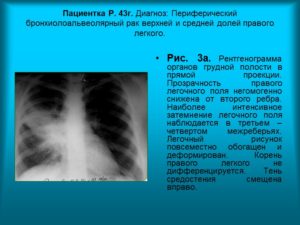 Бурление в легких, расшифруйте диагноз