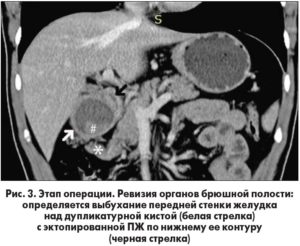 Кистозное расширение железы при эктопии