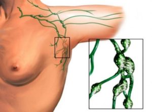 Лимфаденопатия аксилярного узла после лампэктомии