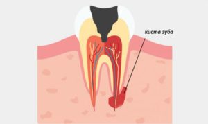 Киста на 36 зубе: лечить или удалять?