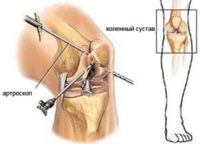 Боль в колене после операции миниска