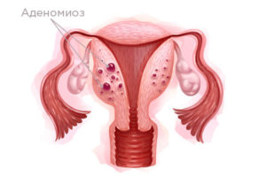 Как влияет флебодия на состояние миомы и активного эндометриоза?