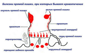 Кровь в кале после удаления геморроя