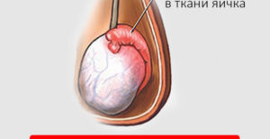 Колит в яичках