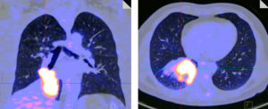 ПЭТ/КТ очаговое образование на легком