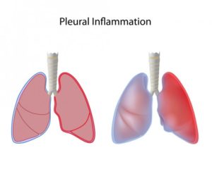 Бронхит или плеврит