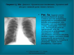 Бурление в легких, расшифруйте диагноз