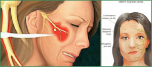 Имплантация при неврите тройничного нерва