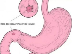 Колоноскопия при язве 12 перстной кишки