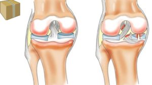 Боль в колене после операции миниска