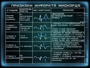 Как прочитать кардиограмму ЭКГ