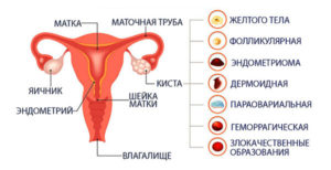 Киста яичника и тонкий эндометрий при планировании беременности