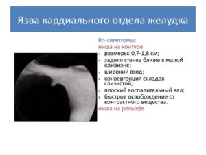 Каллёзная язва субкардиального отдела желудка