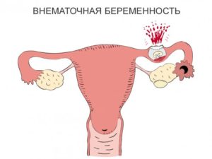 Боюсь внематочной беременности