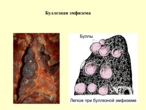 Буллы, эмфизема лёгких, чувство нехватки воздуха