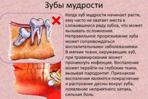 Болит ухо, есть подозрения на зуб мудрости