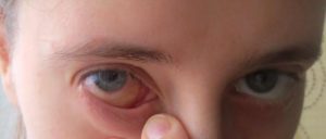 Болит правый глаз изнутри