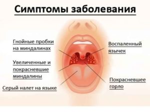 Красное горло антибиотики не помогают