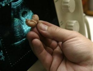 Медикаментозный аборт при замершей беременности