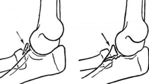 Перелом венечного отростка локтевой кости