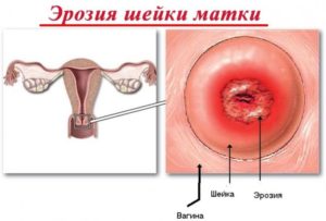 ЛЕЧЕНИЕ УРОПЛАЗМЫ, КИСТЫ И ЭРОЗИИ