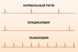 Брадикардия и низкое давление