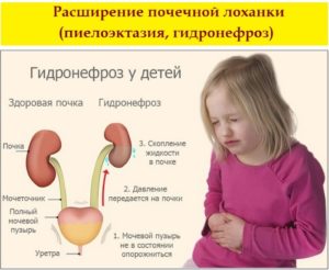 Пиелоэктазия у ребёнка