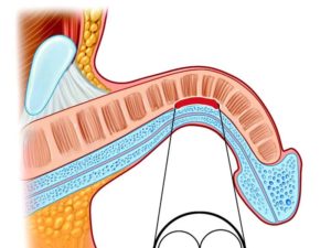Как вылечить искривление полового члена в домашних условиях
