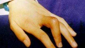 Кривой палец после травмы