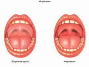 Красное горло и мокрота