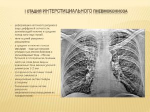 Легочный рисунок неравномерно обогащен