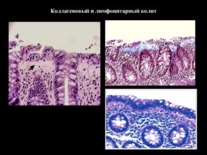 Лимфоцитарный колит
